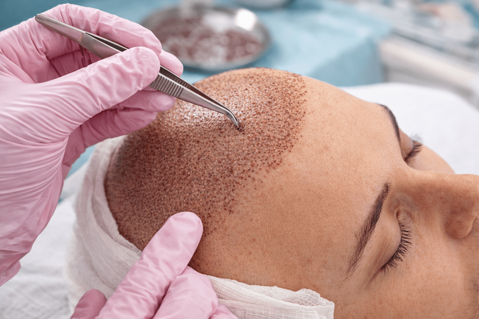 Hair Transplant Min