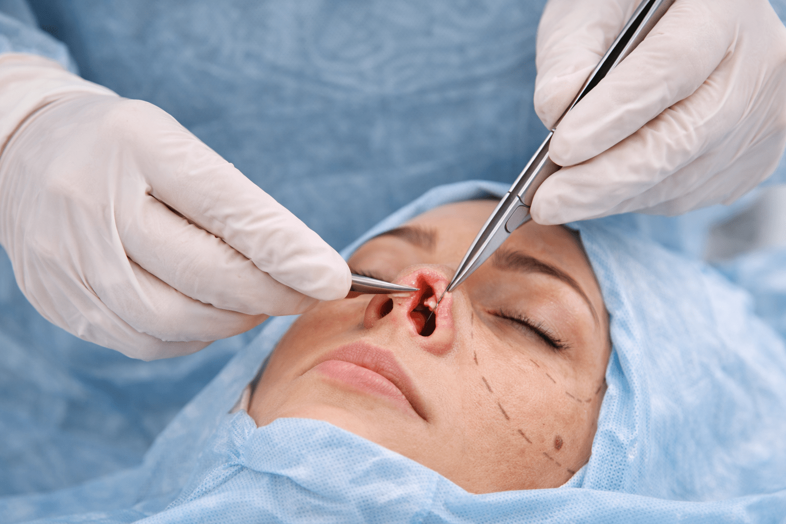 Rhinoplasty1 Min