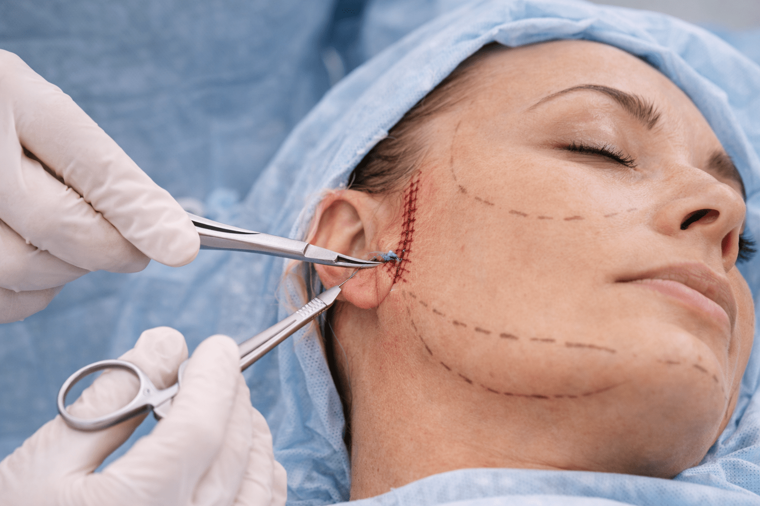 Facelift Min